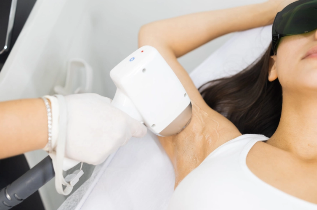 Laser hair removal - Underarm - Nuneaton