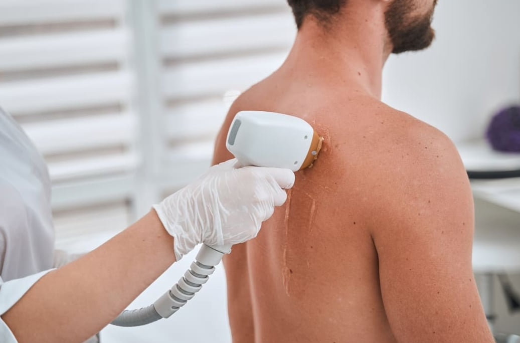 Laser hair removal - Full back - Nuneaton