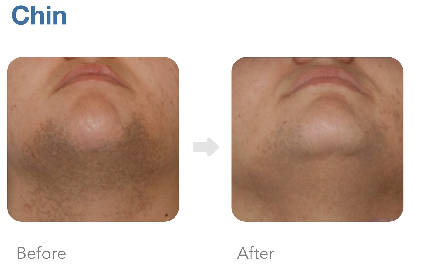 Achieve a cleaner, smoother look with chest laser hair removal. Quick, effective, long-term results. Schedule your treatment now!