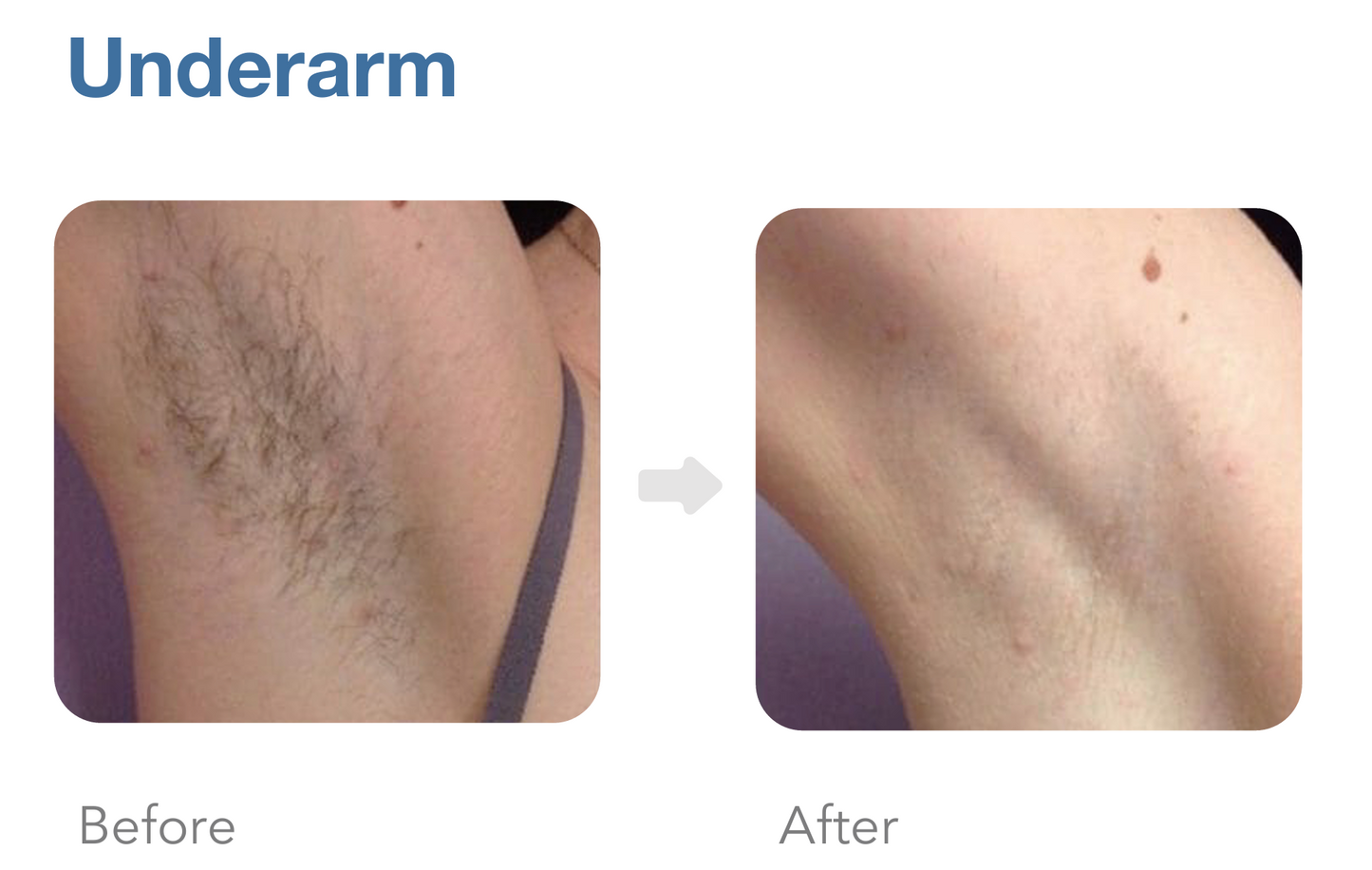 Achieve a cleaner, smoother look with chest laser hair removal. Quick, effective, long-term results. Schedule your treatment now!