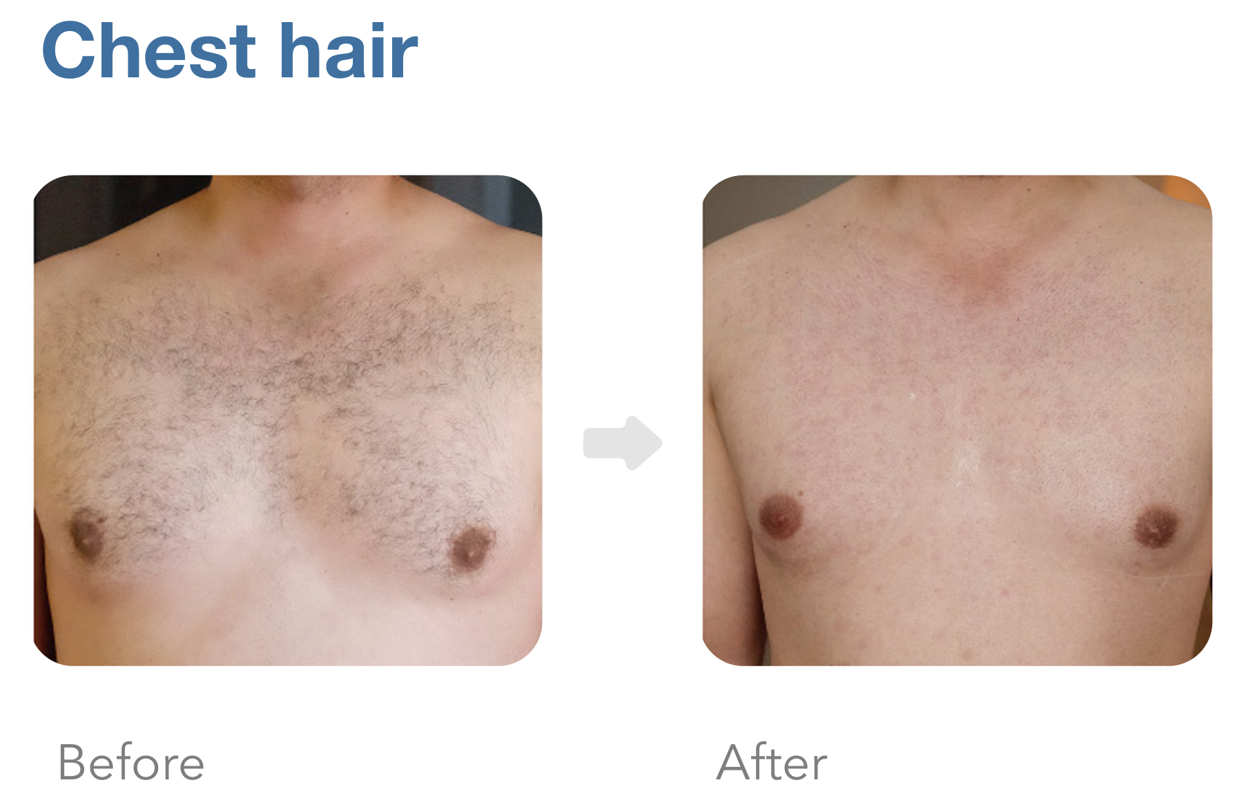 Achieve a cleaner, smoother look with chest laser hair removal. Quick, effective, long-term results. Schedule your treatment now!