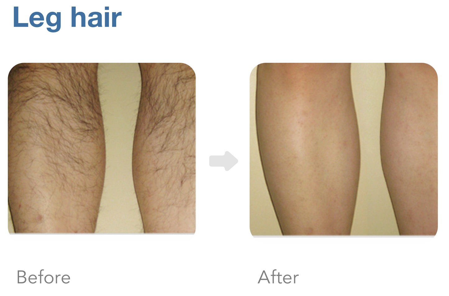 Achieve a cleaner, smoother look with chest laser hair removal. Quick, effective, long-term results. Schedule your treatment now!