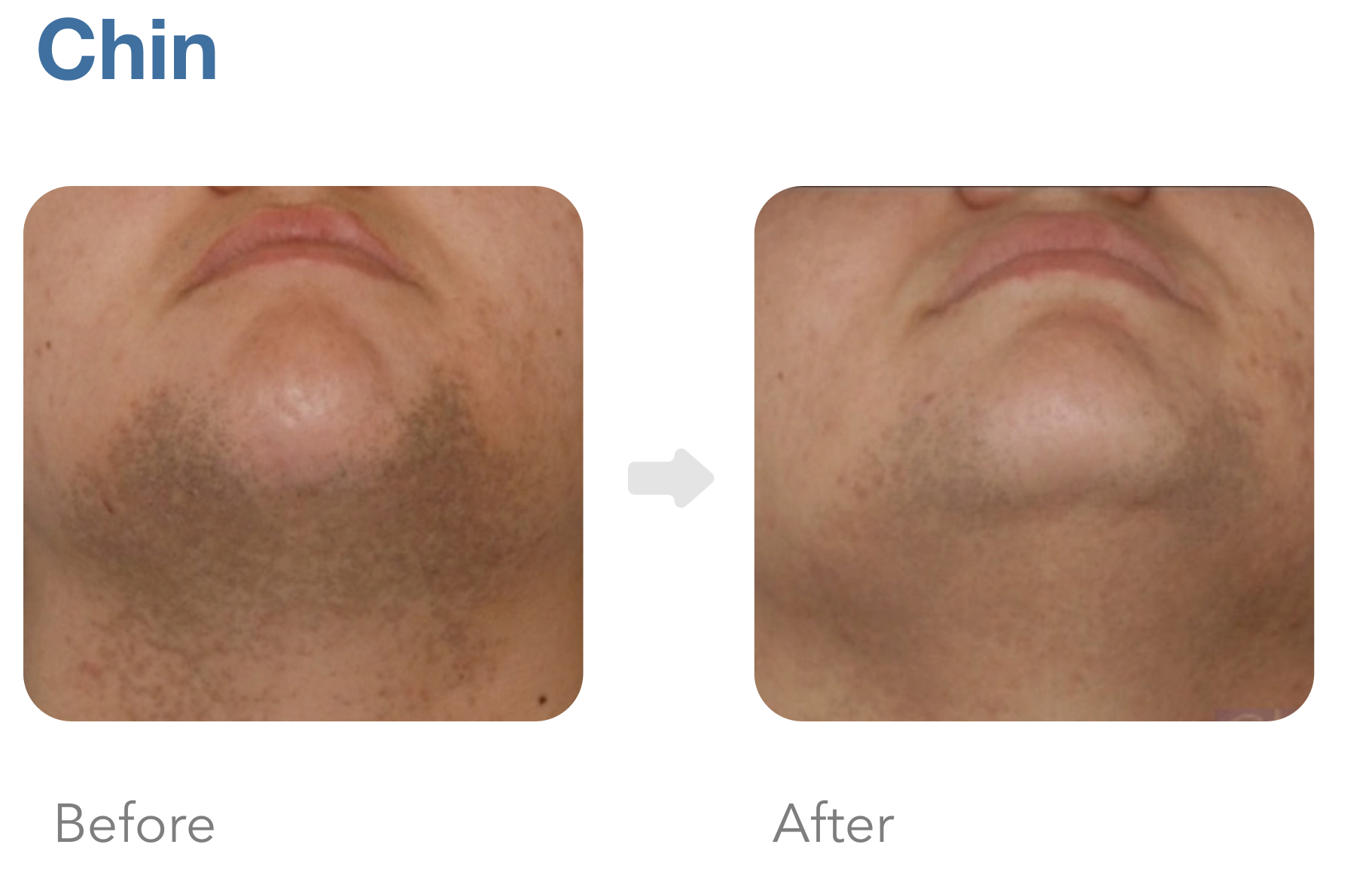 Achieve a cleaner, smoother look with chest laser hair removal. Quick, effective, long-term results. Schedule your treatment now!